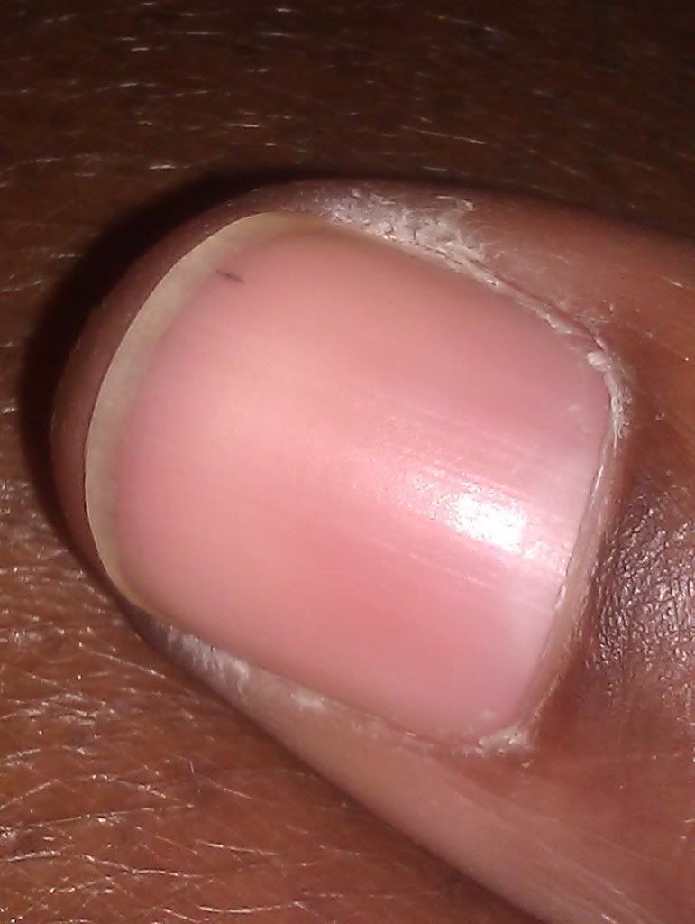 ALERT If You See A Black Stripe Like This On Someone’s Fingernail, Here’s What It Means
