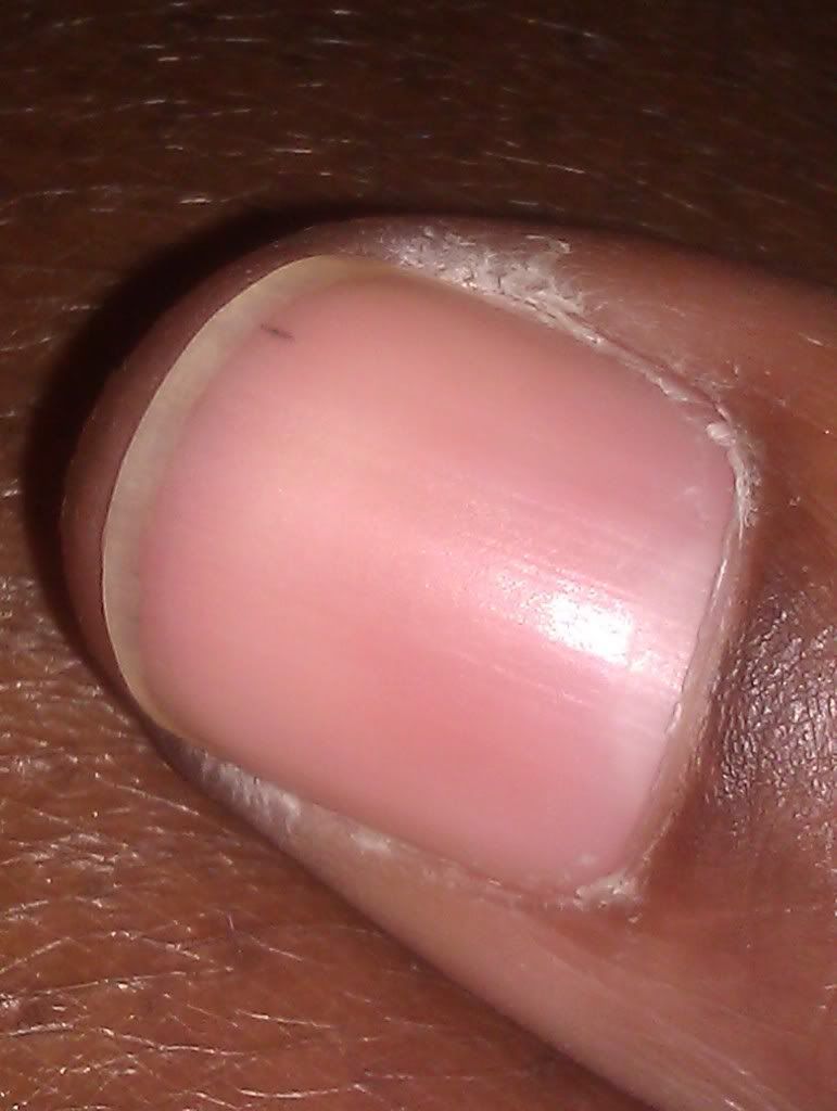 Small Black Vertical Line On Nail